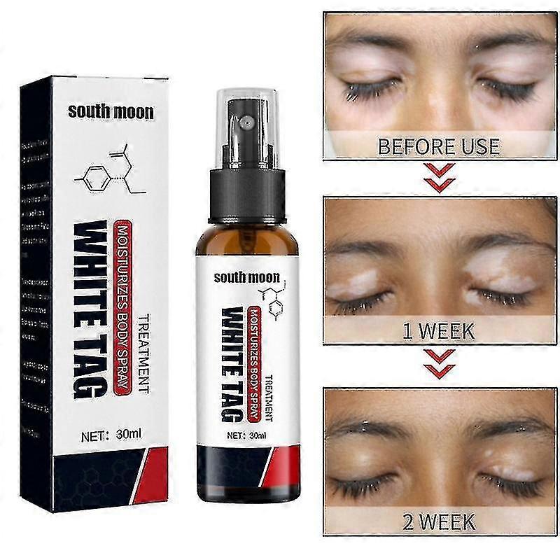 Vitiligo Treatment Spray
