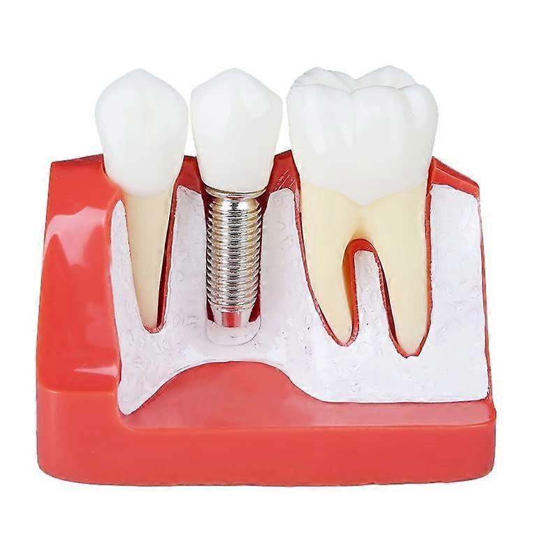 Dental Implant Model with Removable Crown Bridge and Clear Root Visualization for Education  Red
