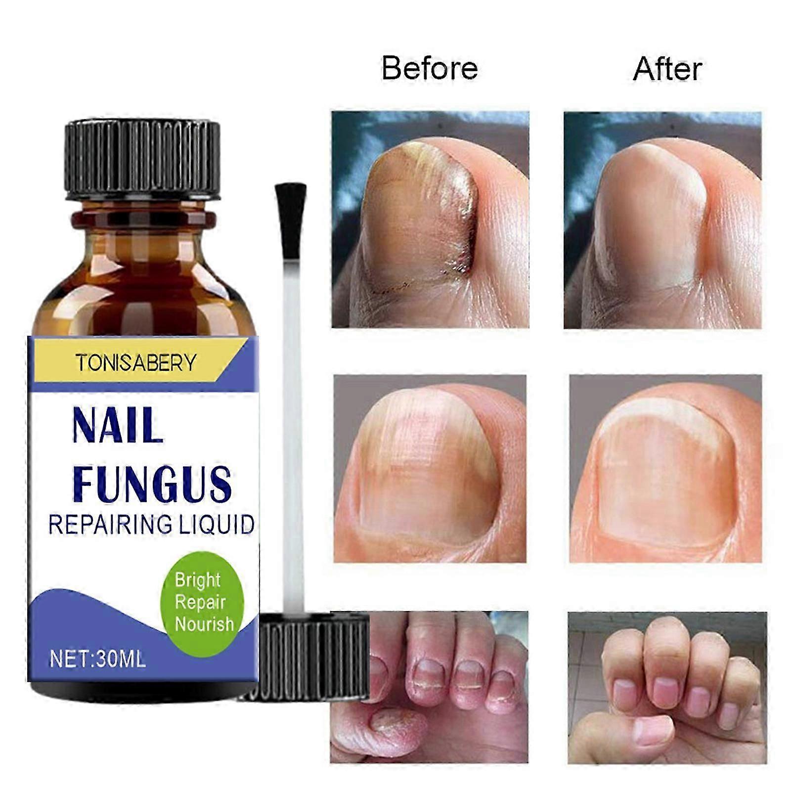 Plesňové ošetrenie nechtov - 30 ml extra silné ošetrenie plesní nechtov na nohách - oprava a posilnenie nechtov proti plesniam
