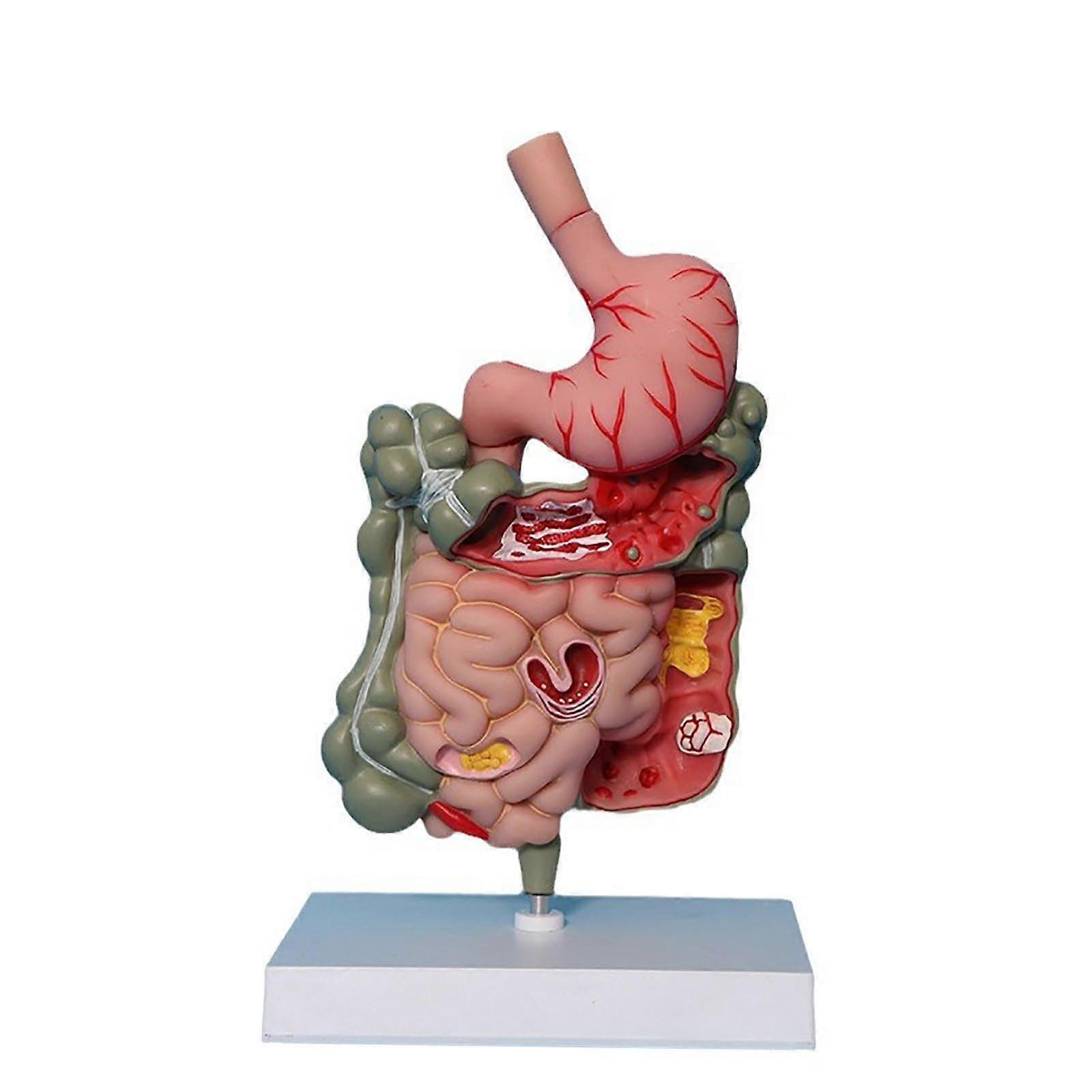 Modelo de Anatomia do Estômago Humano Modelo do Sistema Digestivo Patológico, Modelo de Ensino Removível