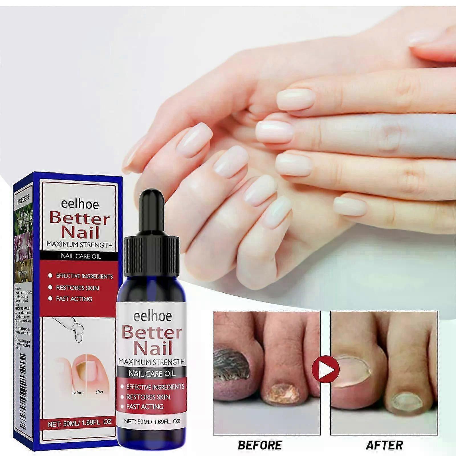 Liečba plesňových nechtovExtra silná liečba plesní nechtov na nohyLiečba plesní nechtov na zahustenieOprava a posilnenie nechtov proti plesniam