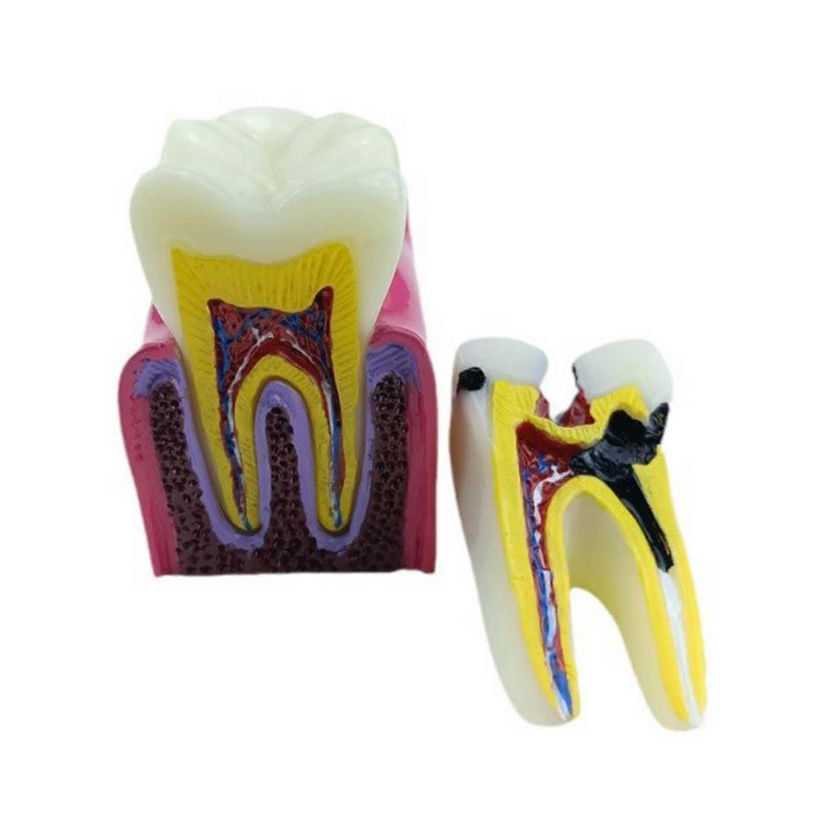 Dental Caries Teaching Model with 6 Types Comparison, Lifesize PVC Tooth Decay Education Aid