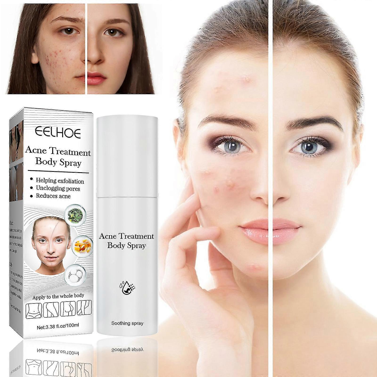 Body Acne Remove Spray Refreshing Oil Control And Shrink Pores For Face & Body