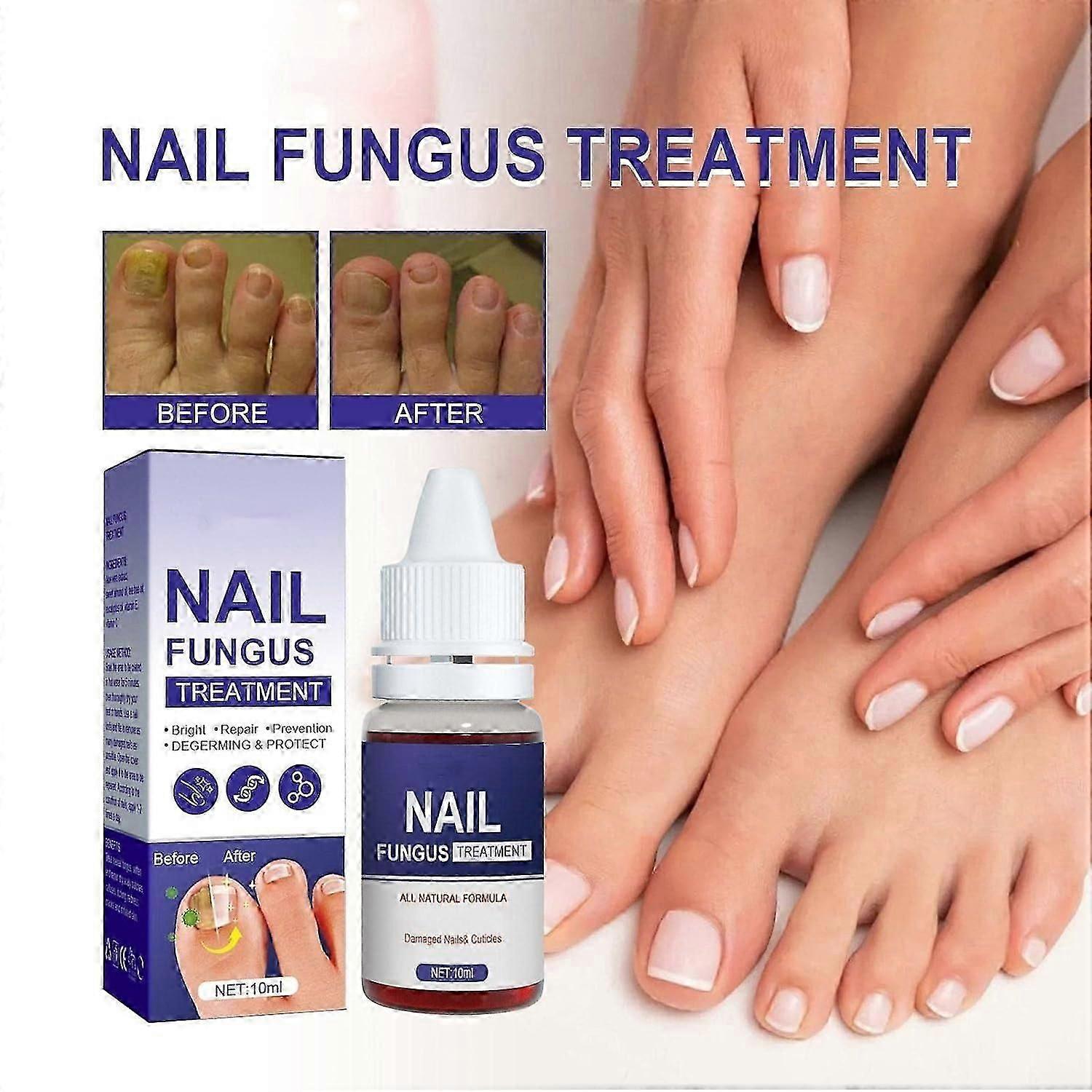 Toenail Fungus Treatment, 10ml Nail Fungus Treatment Extra Strength for Thick, Broken, Discolored & Damaged Nail - Safely and Gently