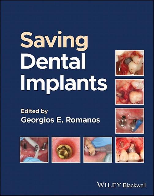 Saving Dental Implants Paperback Book