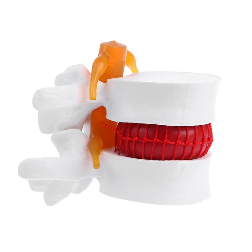 1pc Human Spine Model Lumbar Disc Herniation Presentation Model for School
