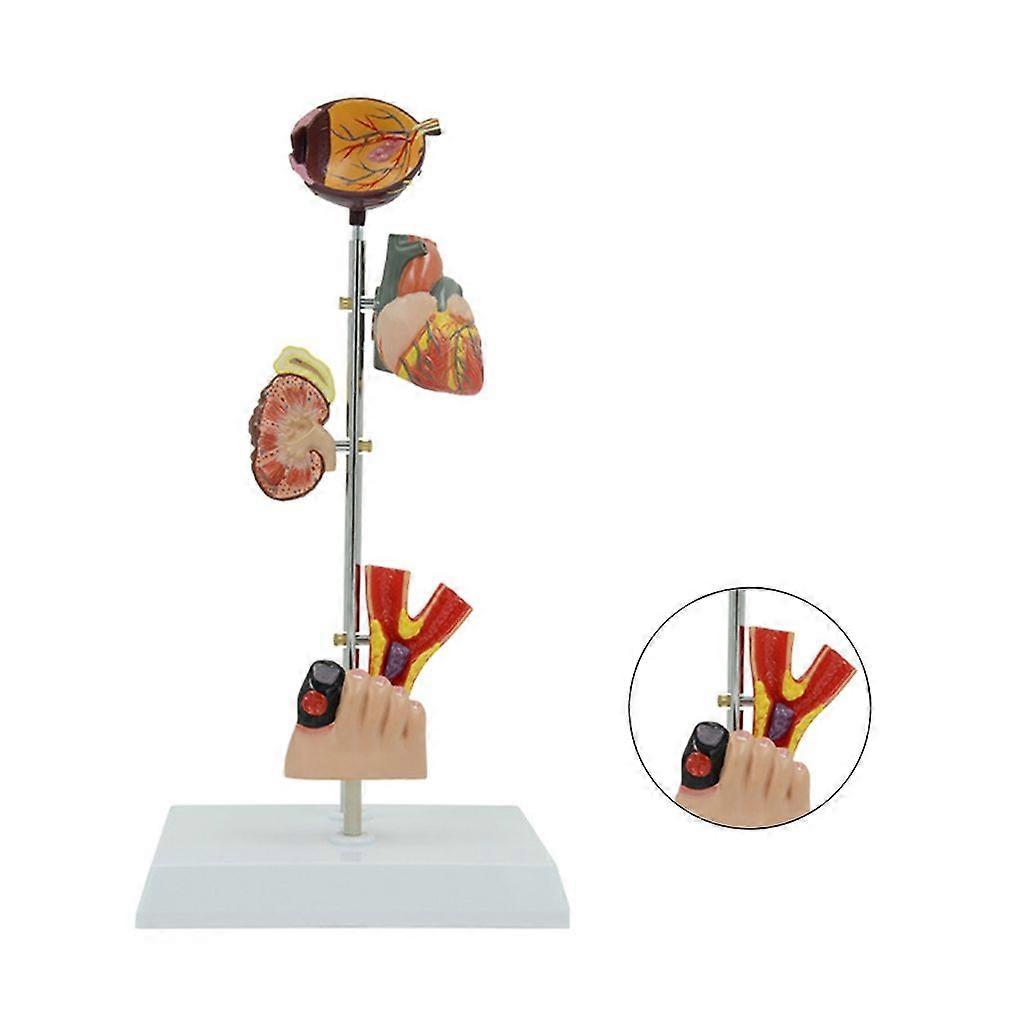Diabetes Pathology Human Organ Anatomy Model