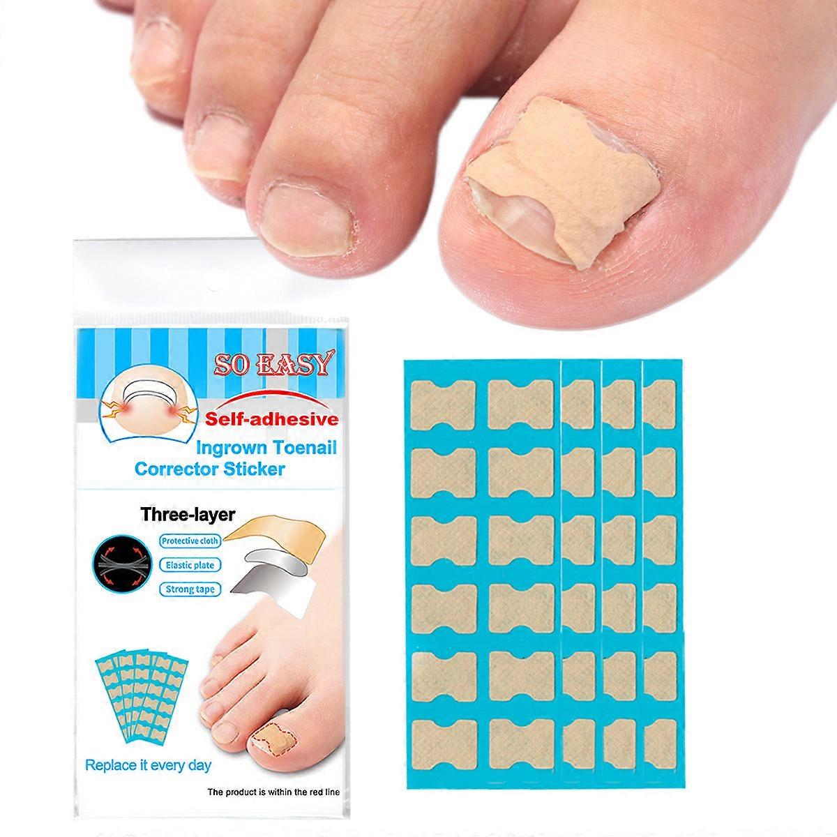 72 stks Nagelcorrectie Stickers Teennagel Patch Ingegroeide Paronychia Pedicure Tool Teen Inlay Corrector Elastische Nagel Patch