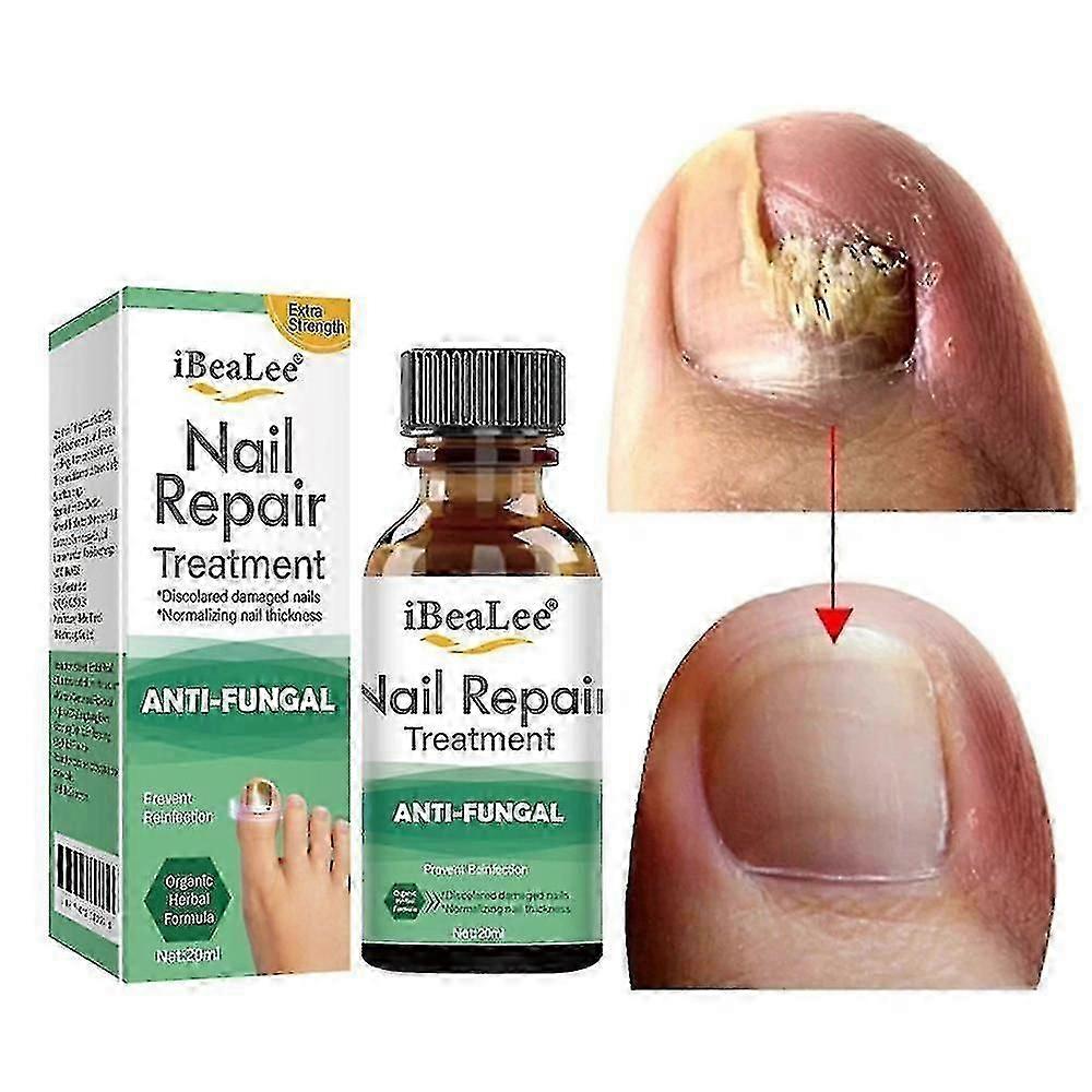 علاج فطريات القدم Minglan لإصبع القدم عامل مضاد للفطريات زيت بشرة طلاء الأظافر مزيل فطار الأظافر الطب العناية بالقدم الجمال