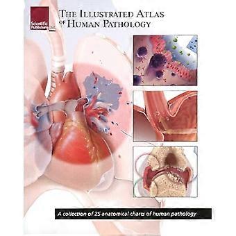 Illustré de Atlas de pathologie humaine : une Collection de 25 tableaux anatomiques de pathologie humaine