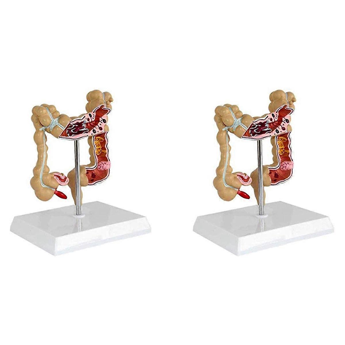 2X Colon Pathological Colorectal Model Large Intestine Model Gastrointestinal Anatomical Model
