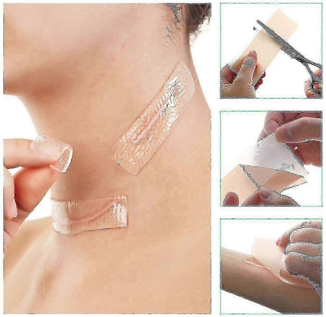 Narbenaufkleber Selbstklebende Narbenaufkleber Wundaufkleber Kaiserschnitt Chirurgie Fade Narben Wiederverwendbare und effektive Narbenentfernung Platte Narbe Tap Roller
