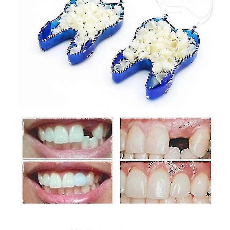 Adjustable Temporary Denture Braces for Missing & Broken Teeth with Upper Occlusion Veneer Dentures