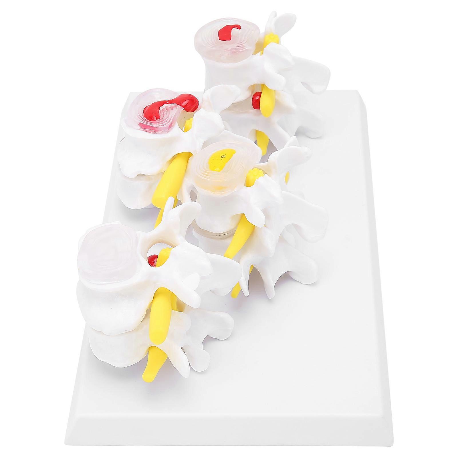 4-Stage Lumbar Vertebrae Spine Model PVC Normal & Pathological Base