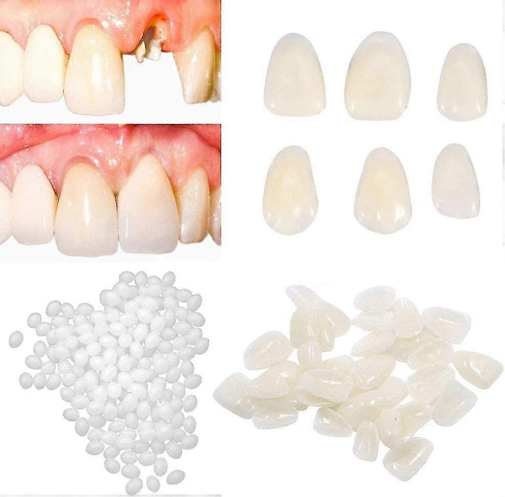 2pcs Temporary Tooth Repair Kit For Filling The Missing Broken Tooth And Gaps-moldable Fake Teeth