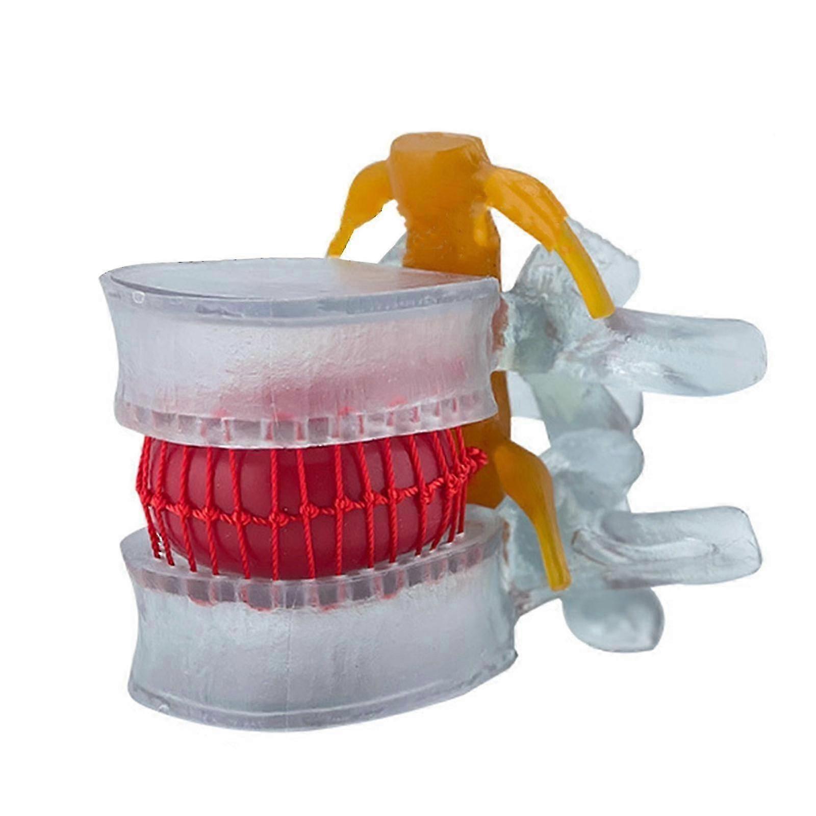 Pathological lumbar disc model for medical training with protrusion