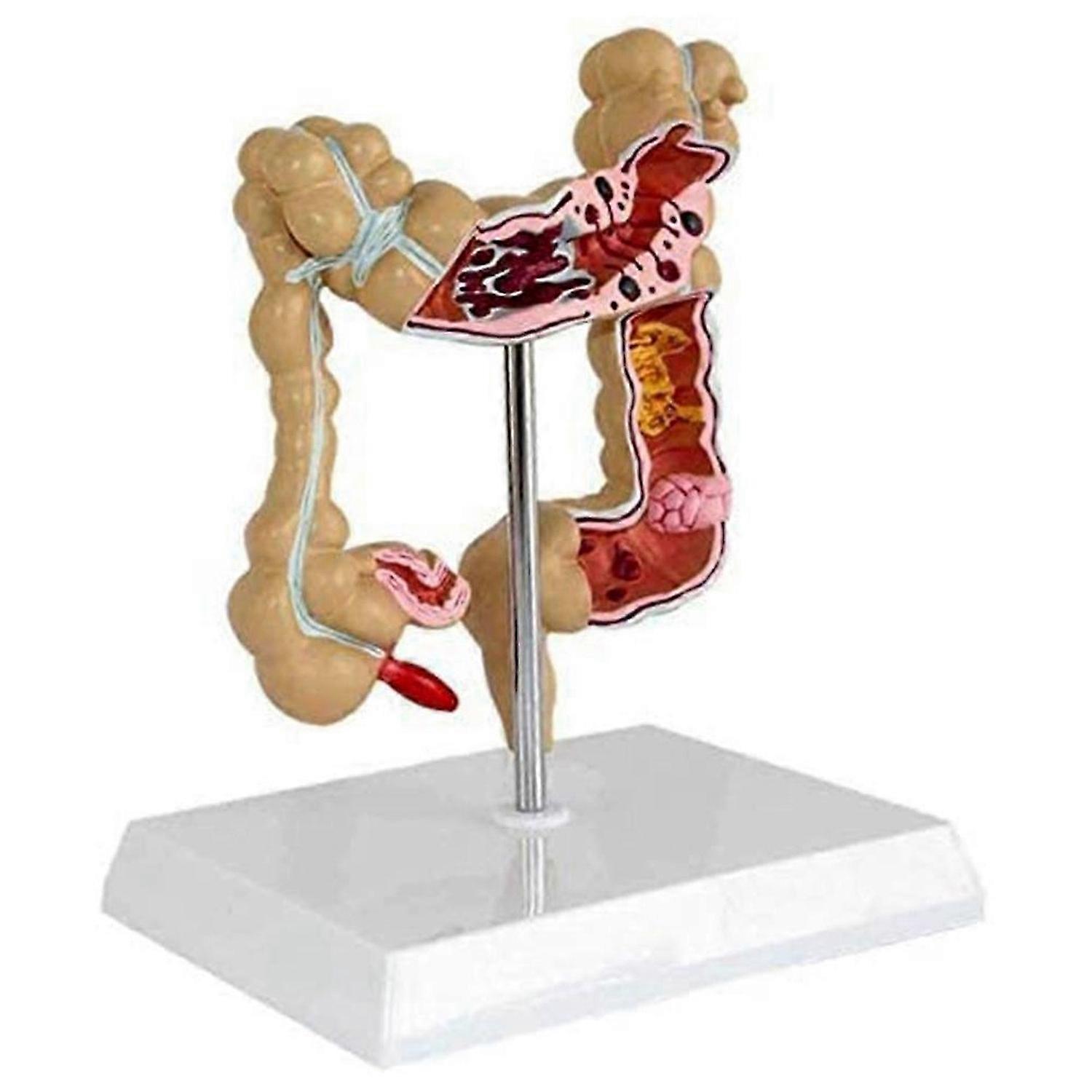 Pathological Colorectal Model Large Intestine Model Gastrointestinal Anatomical Model