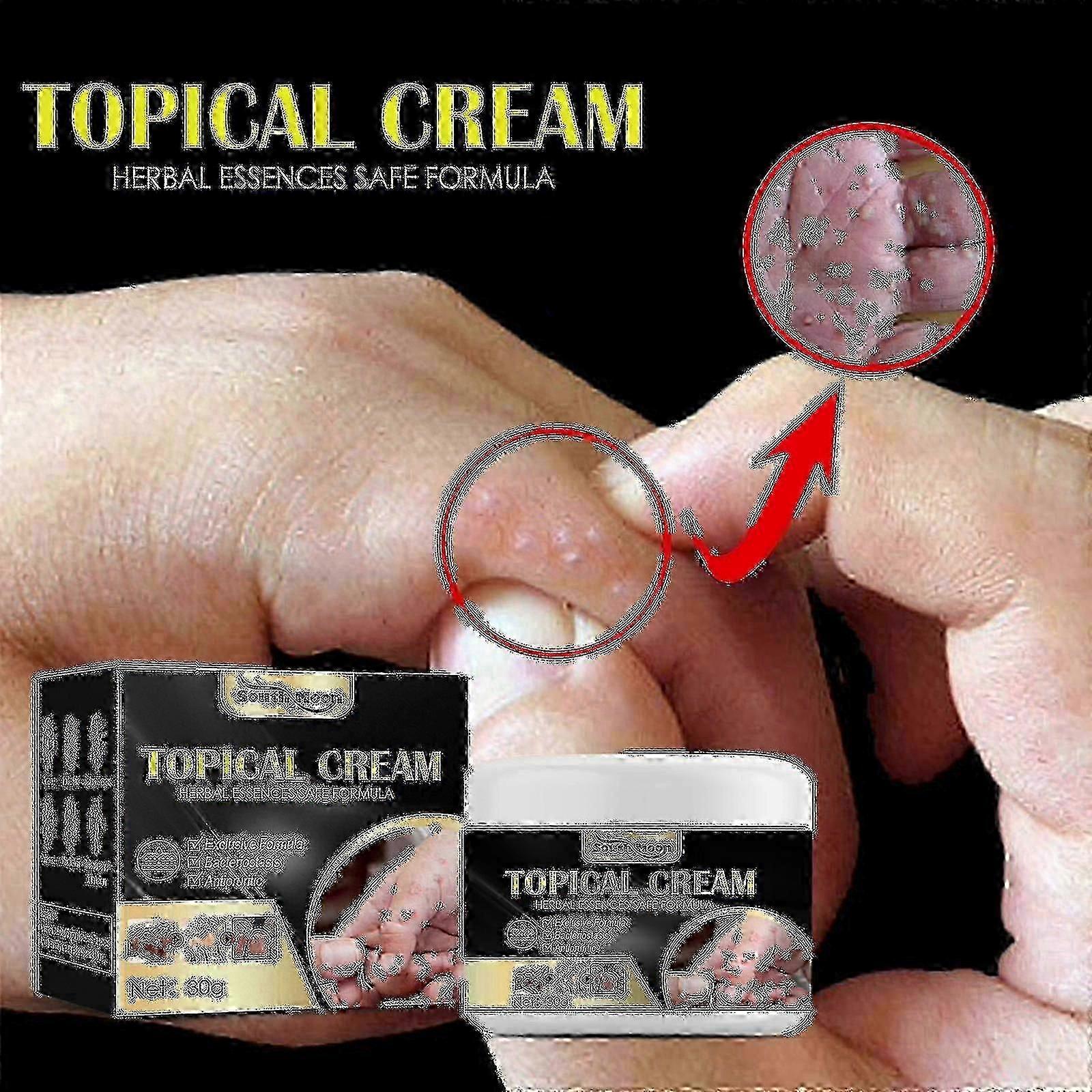 Improved 3-Piece Anti-itch Cream for Dry Skin & Mosquito Bites, Specifically for Sweaty Hands and Feet