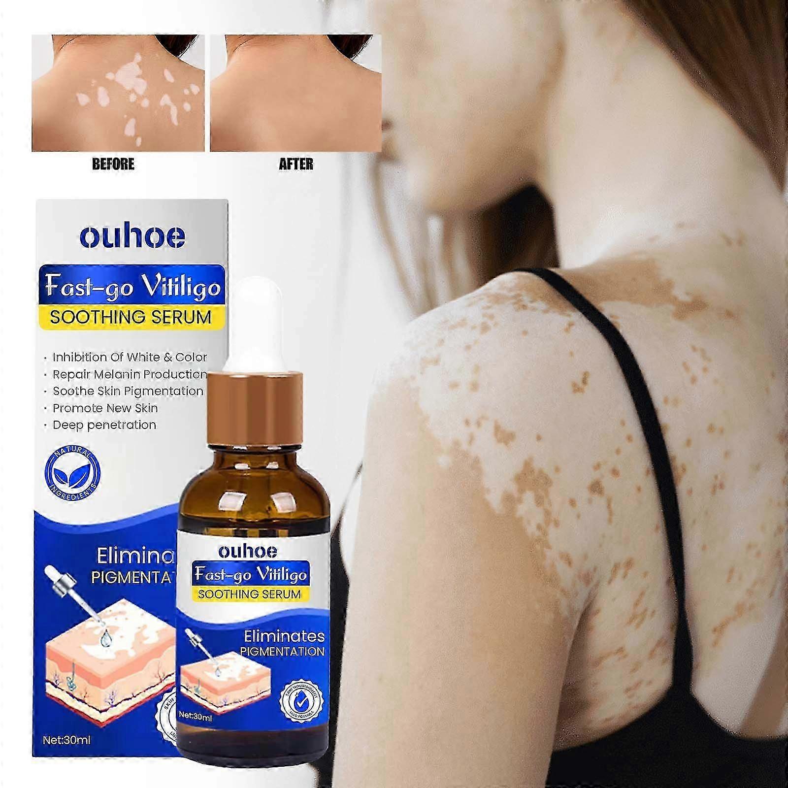 white spot care essence contains saffron extract, dodder extract, psoralen