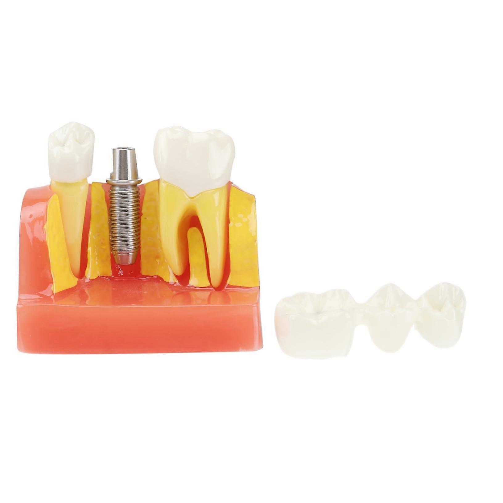 Dental Teaching Model with Removable Teeth, 4X Enlarged Anatomy for Classroom Demonstration