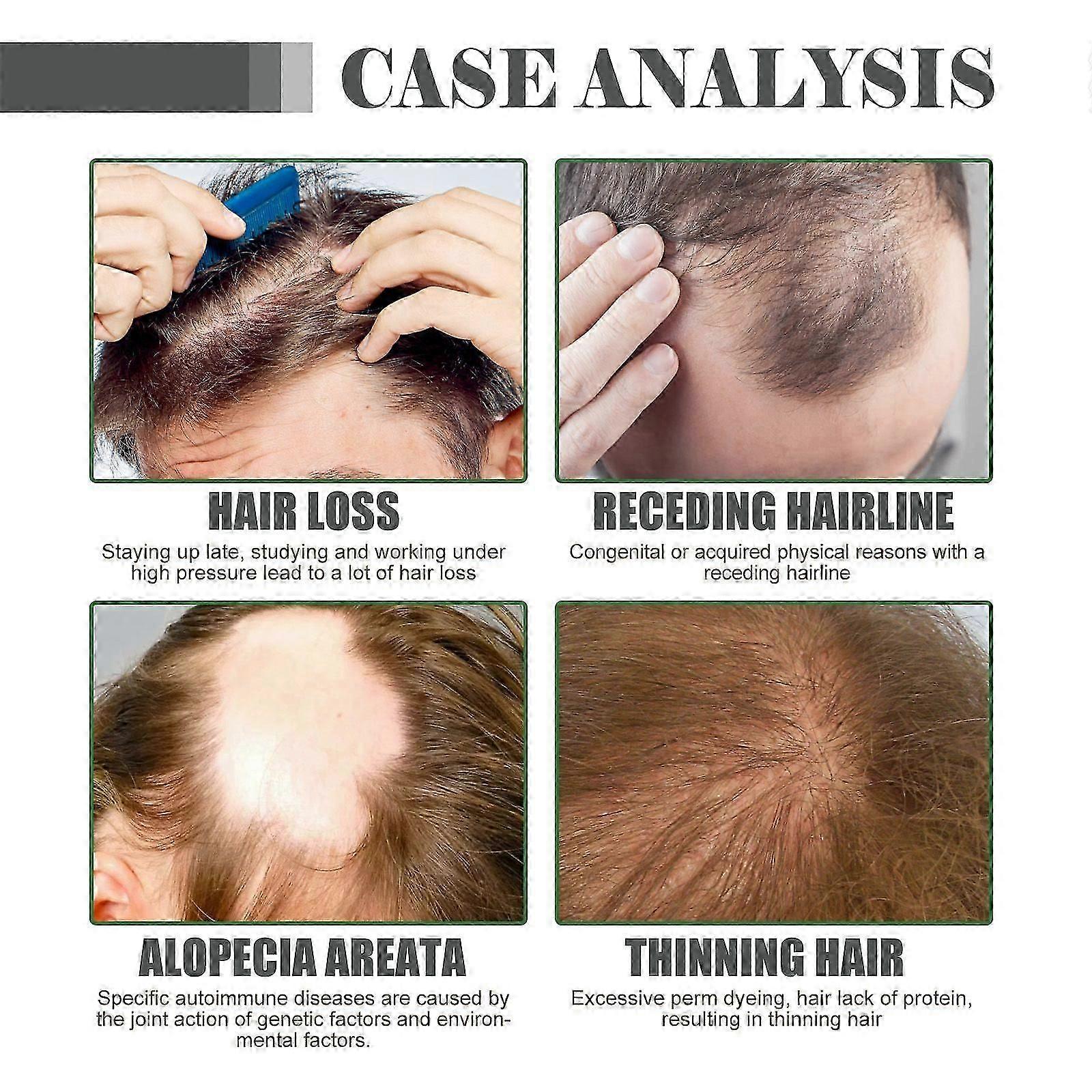 Luxe Roots Haarwachstums Essenzol, עיסוי קרקפת טיפוח מניעה שיער מוצק לח רך שופע שמן לשיער צפוף