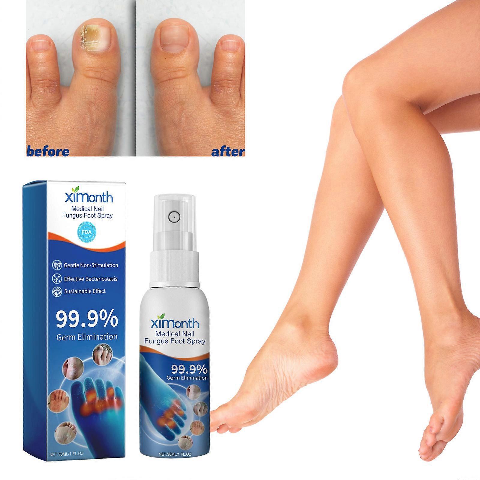 Spray médical pour les ongles pour les ongles, traitement des champignons des ongles, traitement des champignons des ongles extra forts pour les doigts et les ongles des pieds