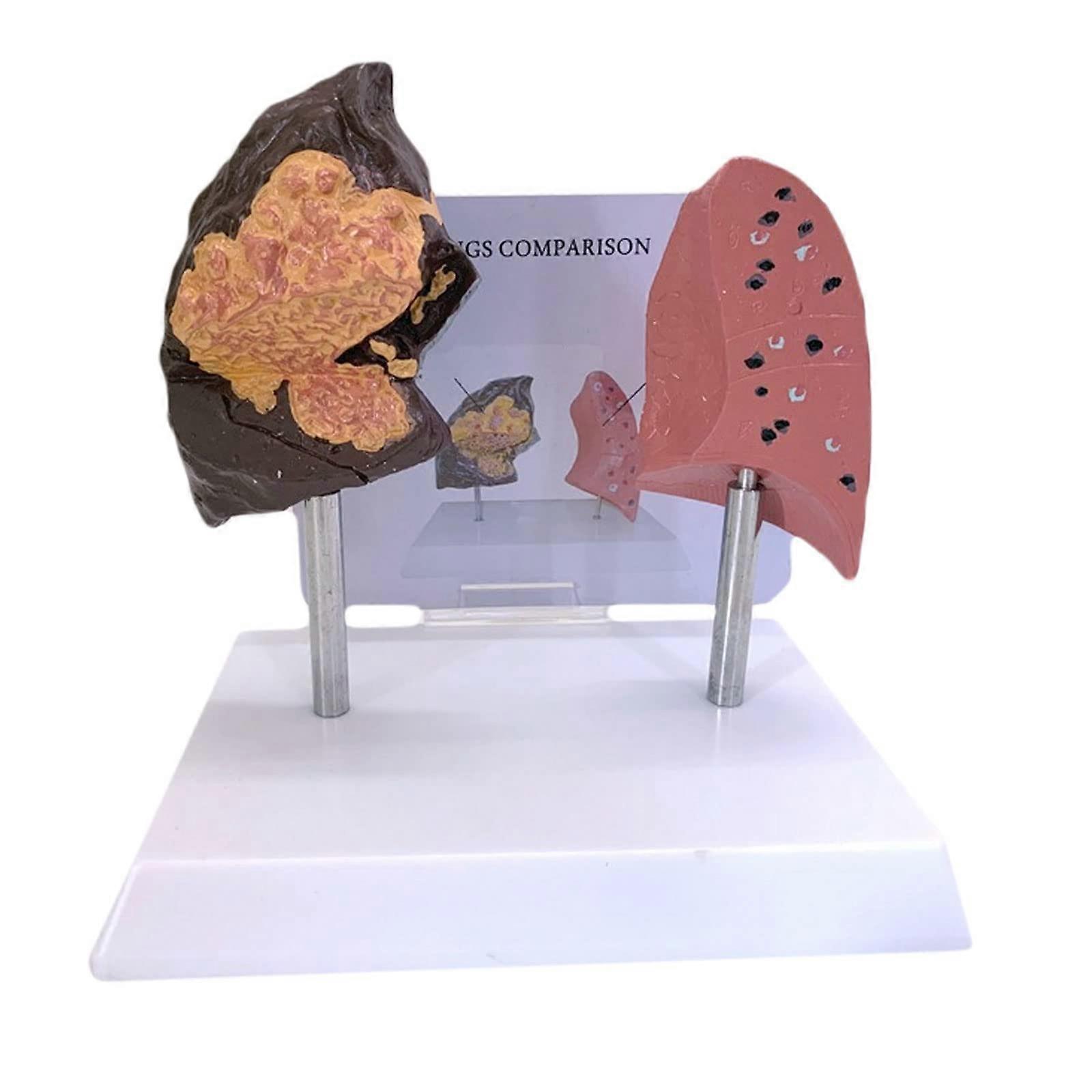 Smoking Lung and Normal Lung, Comparison Organ Model, Pathological Lung Anatomy Model, for Study Teaching, Medical Model