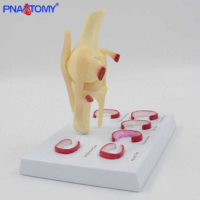 Life Size Knee Joint Model With Ligaments Shows Meniscus Tears Medical Teaching Tool Anatomical Model Skeleton Anatomy Toy