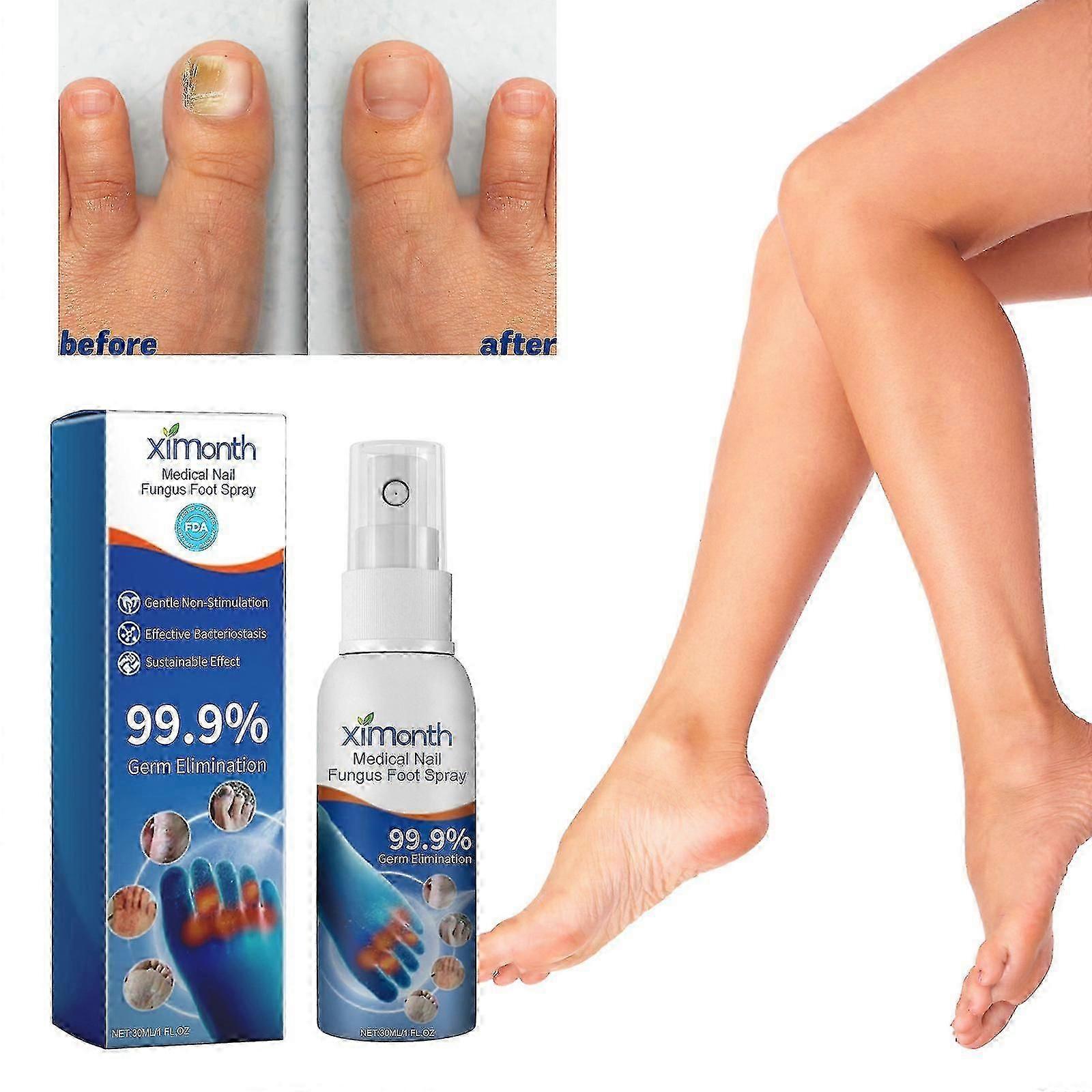 פטרת ציפורניים רפואית תרסיס לכף הרגל, טיפול בצמחי מרפא תרסיס לכף הרגל לציפורניים, תרסיס לטיפול בפטרת כף הרגל תרסיס לתיקון ציפורניים