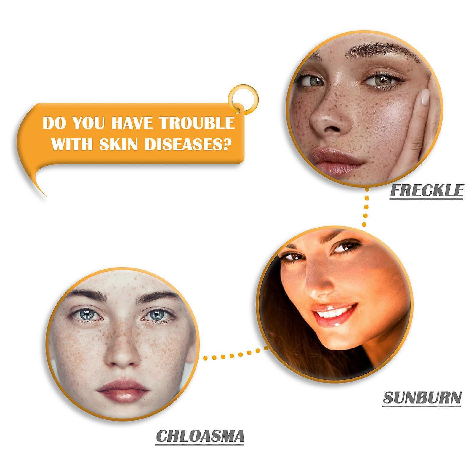 100g Varicose Veins Soap Varicose Vein Soothing Soap Improve Circulation