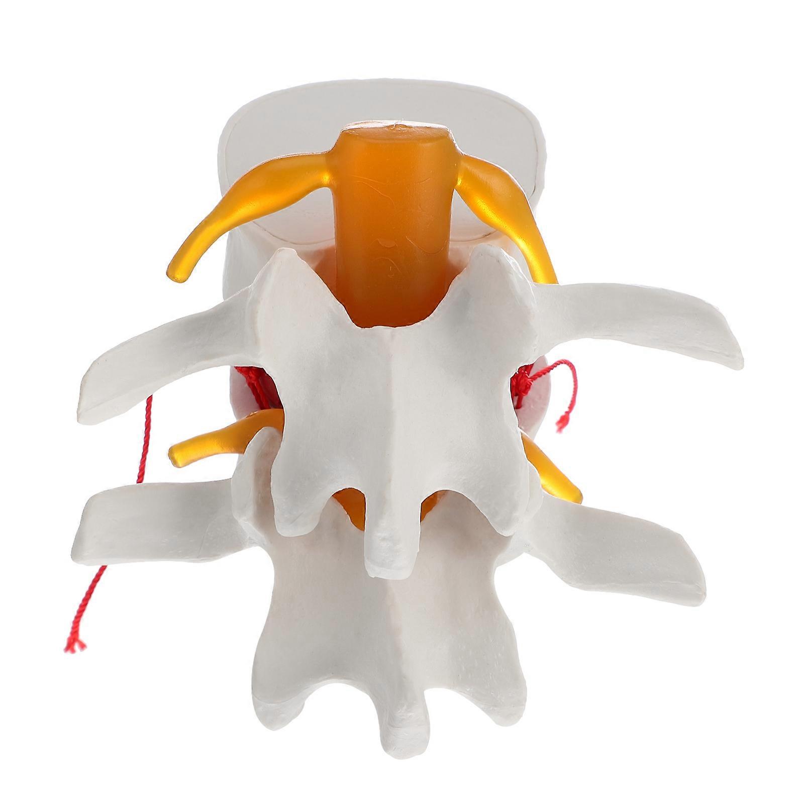 1Pc Human Spine Model Lumbar Disc Herniation Presentation Model for School