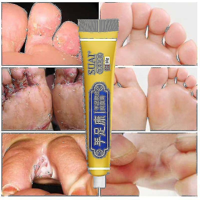 Fungus Removal Cream Foot Cracked Pe