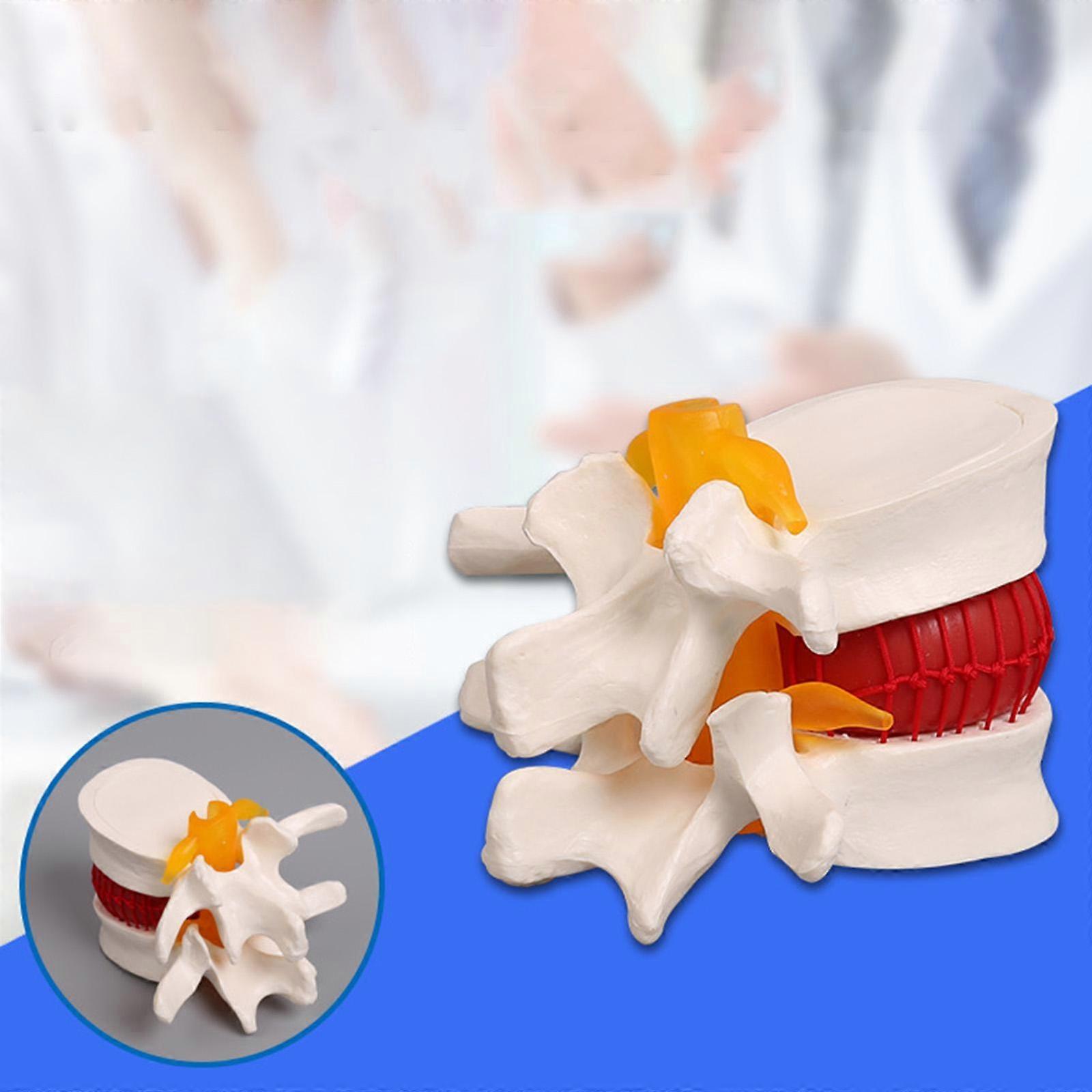 Anatomical Lumbar Disc Herniation Model Anatomy Tool