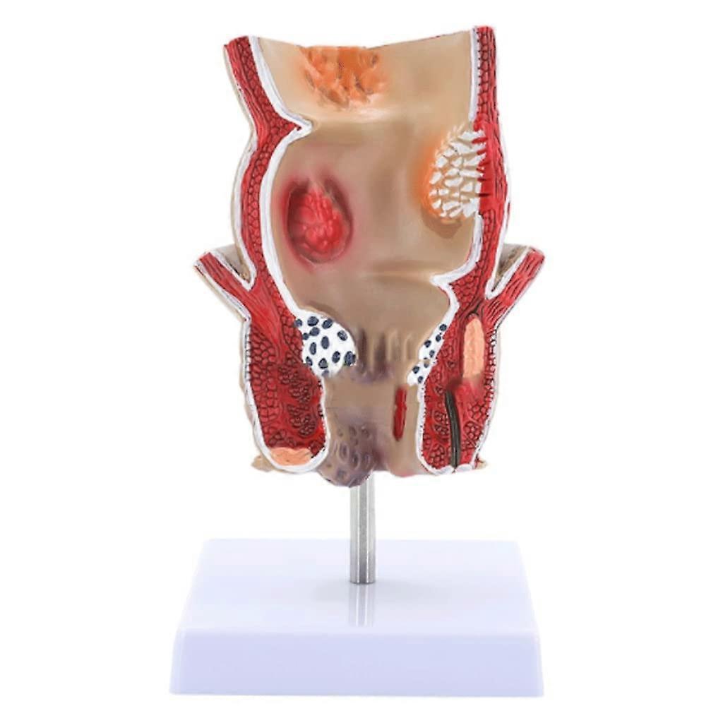 Anorectal Pathological Model For Teaching Internal And External Hemorrhoid Rectal Lesion Human Anatomy LifeSize Resin