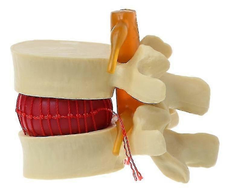 Lumbar Spinal Disc Herniated Spine Anatomical Anatoyellow1pcsmodel