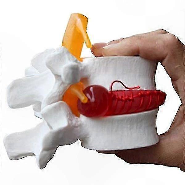 Anatomical Lumbar Disc Herniation Spine Model in White Color for Educational Use