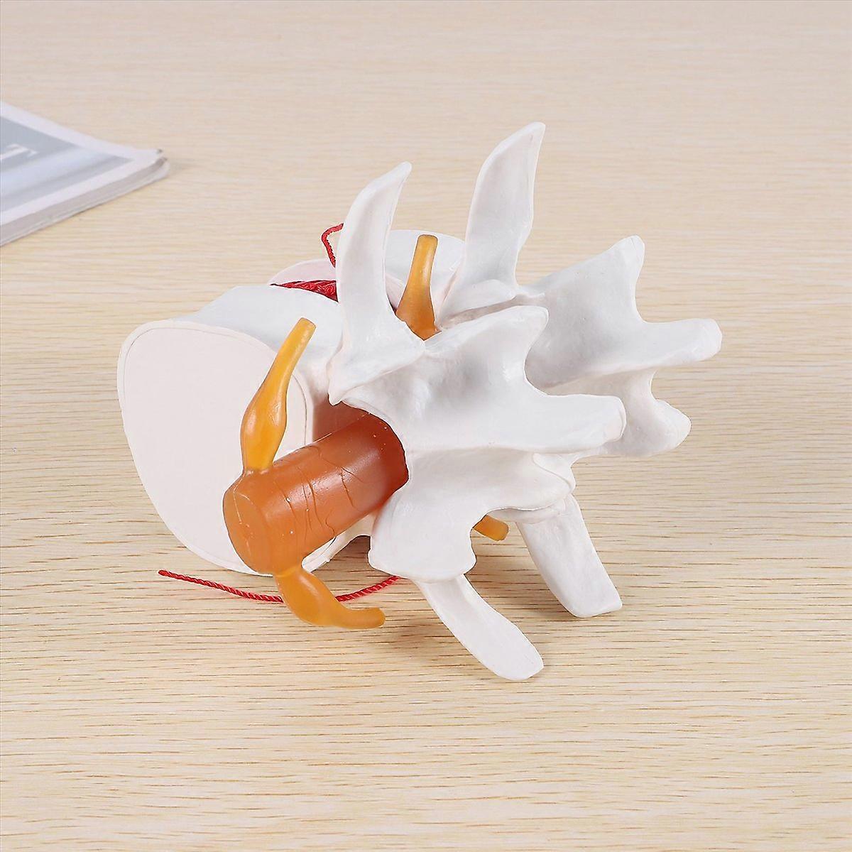 1:1.5 Lumbar Disc Herniation Demonstration Model for Human Anatomy