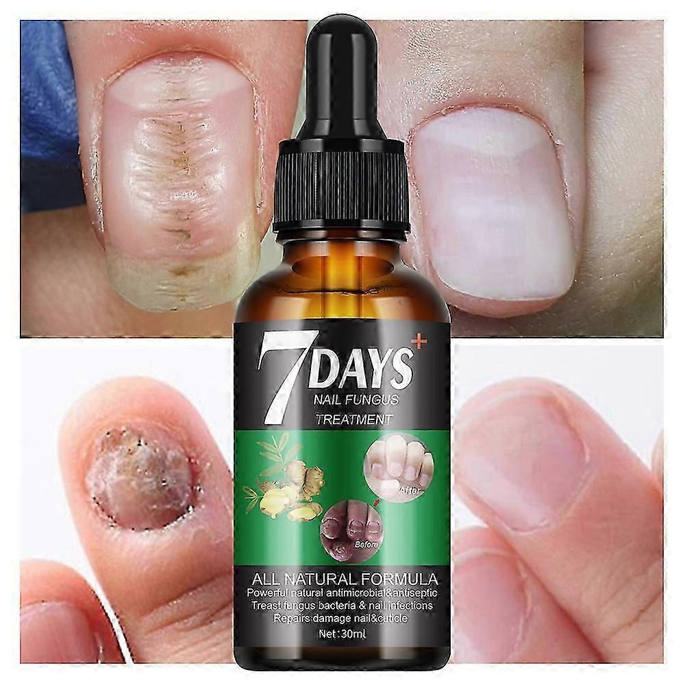 7 jours de traitement des champignons des ongles, 7 jours de croissance des ongles et de renforcement des ongles, solution de réparation des ongles, restauration d’ongles sains