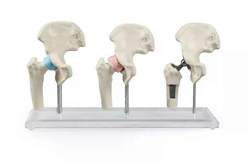 Model van heupimplantaat