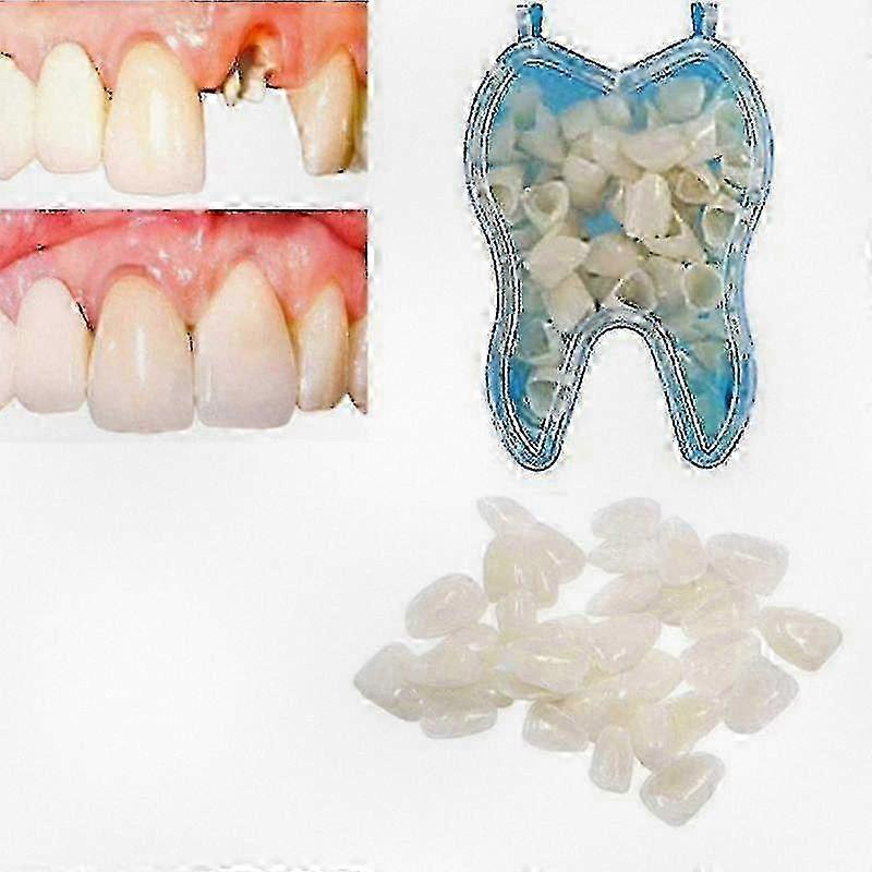 Adjustable Denture Braces for Upper Teeth Replacement, Veneer Dentures, Missing or Broken Teeth, and Tooth Gap Solutions
