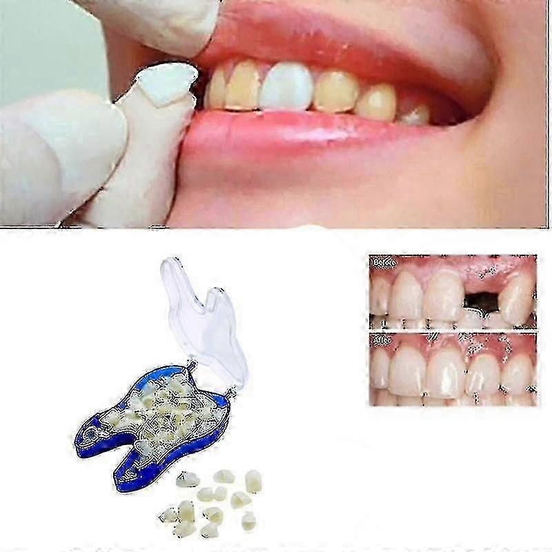 Temporary Dentures Occlusal Upper Dentures, Veneers, Missing Teeth, Broken Teeth And Interdental Spaces, Front Teeth + Back Teeth