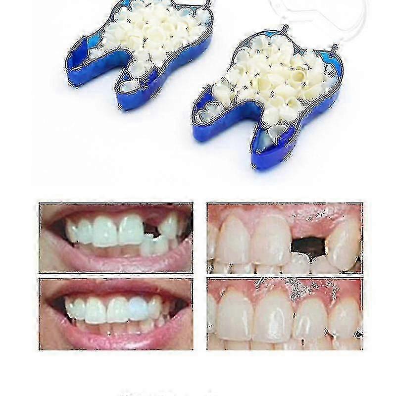 Temporary Denture Braces Occlude Upper Dentures Veneer Dentures Missing Teeth Broken Teeth Elq