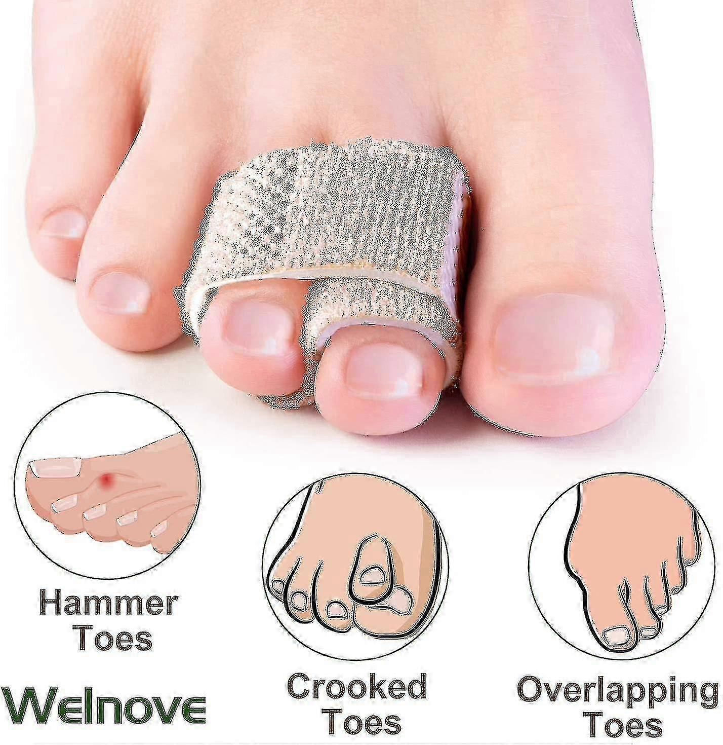 6 stk Hammer Toe rettetang for å rette skjeve tær overlappende tær