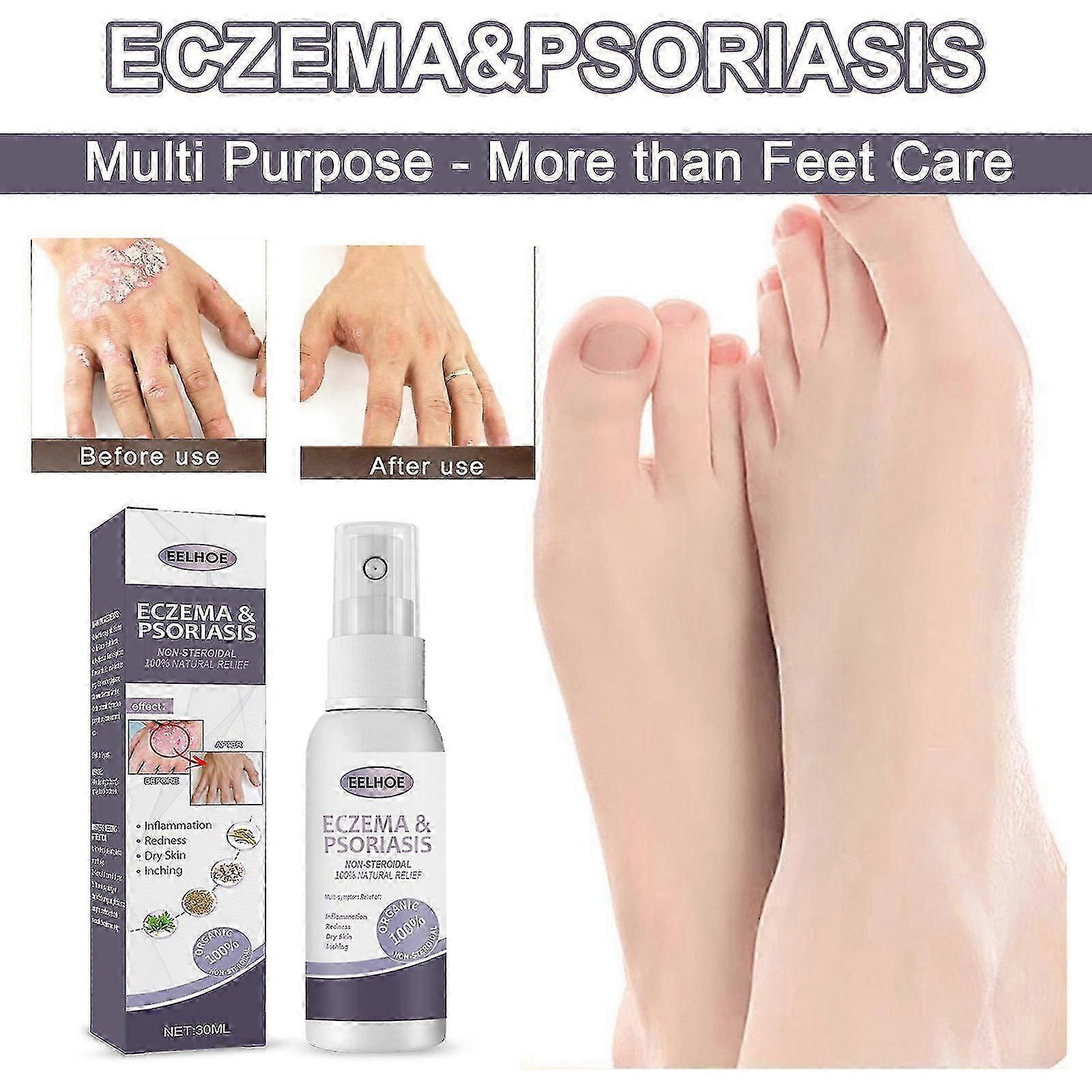 high qualityPsoriasis For Psoriasis Psoriasis