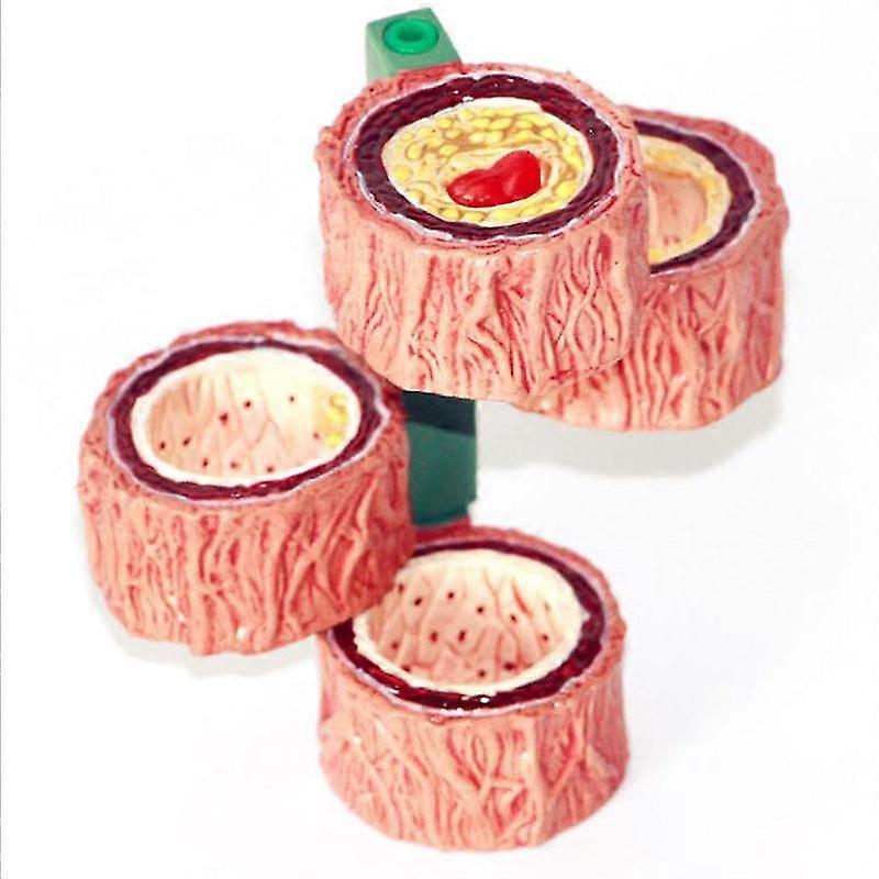 Human atherosclerosis model thrombosis model artery model thrombosis evolution anatomy medical teaching tool