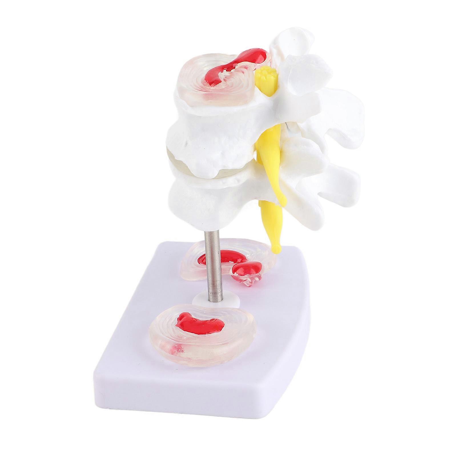 Anatomical Lumbar Disc Herniation Model PVC Human Spine Training Tool