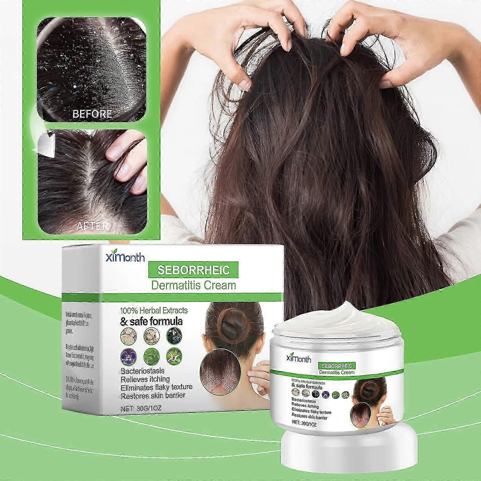 Seborrheic Dermatitis Cream, Fast Acting Seborrheic Dermatitis Scalp Treatment, Gives Comfort and Relief on Dry and Itchy Scalp, Anti-Itch for Dandruf
