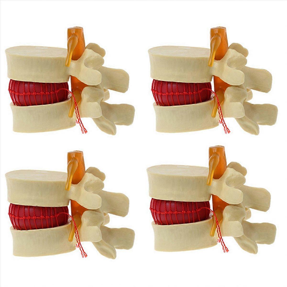 Lumbar Vertebrae Model Lumbar Disc Herniation Anatomy Teaching Tool