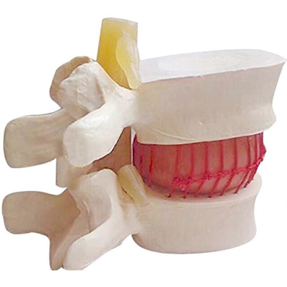 1 Anatomická herniace bederního disku Bederní páteř Model bílé barvy