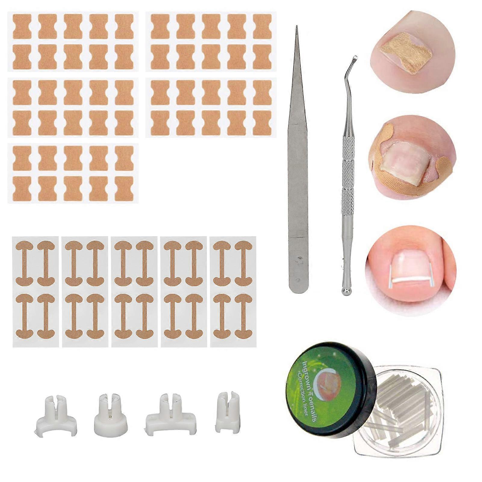 Ingrown Toenail Treatment Kit Glue Free Pedicure Ingrown Toenail Corrective Patches Tool 